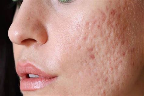 How to naturally treat acne scars - The Statesman