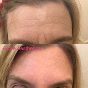 Before/After - Allure Aesthetics - Med Spa Great Falls, MT