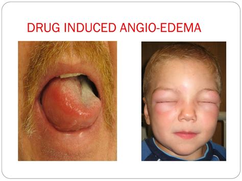 PPT - CUTANEOUS DRUG ERUPTIONS PowerPoint Presentation, free download