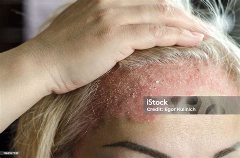 penyakit kulit dermatologis psoriasis eksim dermatitis alergi lesi