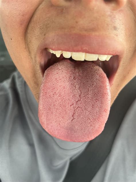 Sore white spots on center of tongue. HPV? : r/DoctorMike