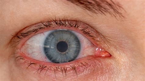 Ask a doctor: ‘Why are my eyes often bloodshot?’ | Fox News