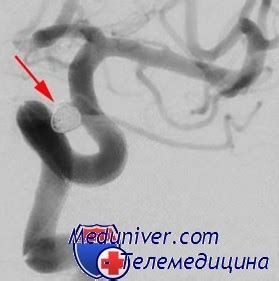 История эндоваскулярного лечения аневризм головного мозга. Этапы