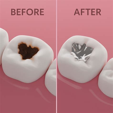 White vs. Silver Fillings: Pros, Cons, and How to Choose