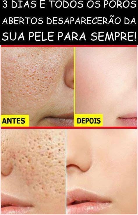 Tratamento Fechar Poros Rosto - 8 dicas para fechar os poros dilatados da pele | Tratamento de beleza ...
