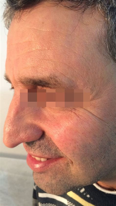 mole removal cost  insurance financial report