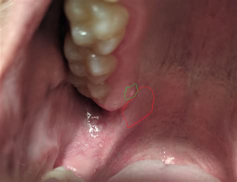 Palatoglossal Arch Bump Nonneoplastic Tongue Swellings Of Lymphatic
