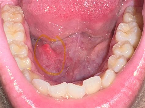 What’s this lump inside my mouth? it’s pretty painful when I drink