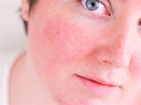 Rosácea - Dra. Ericka Aguiar - Dermatologista Clínica, Facial, Corporal ...