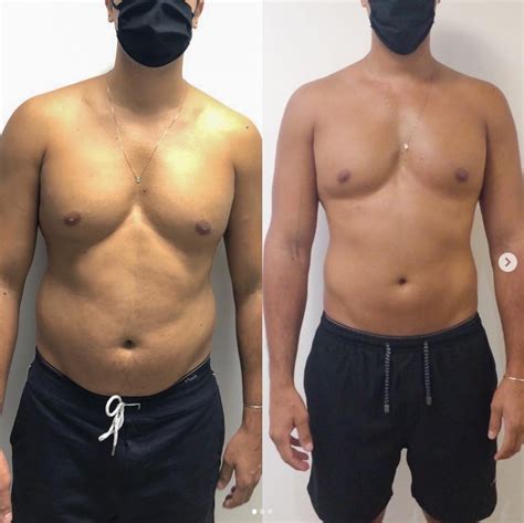 Enzima Intramuscular Antes E Depois - APLICAÇÃO DE ENZIMAS – EPH – Estetica para Homens