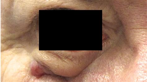 Advanced BCC on Eyelid | Erivedge® (vismodegib)