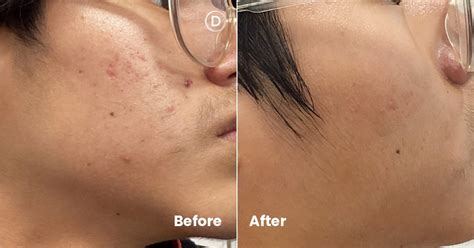 clear skin   creams  power  topical acne treatment