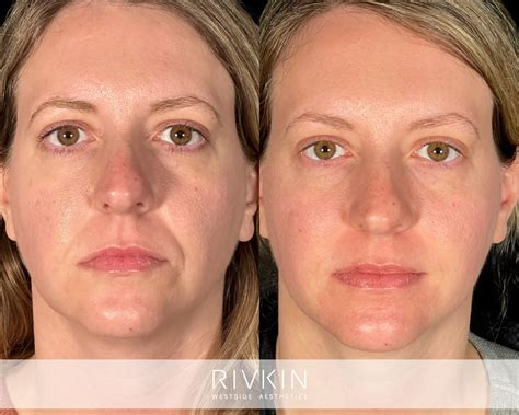 nasolabial folds rivkin aesthetics