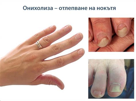 Онихолиза – отлепване на нокътя | ArsMedica.bg