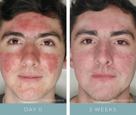 salicylic acid burn  ella hogarth blog