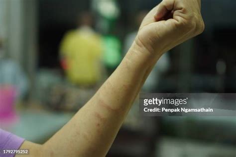 Skin Rash Arm Photos and Premium High Res Pictures - Getty Images