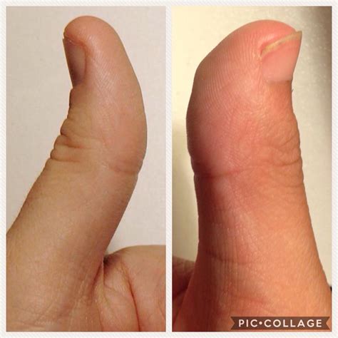 thumb club 5