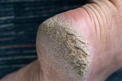 Cracked Heels & Dry Skin | By Steady Gait Foot Clinic in Scarborough