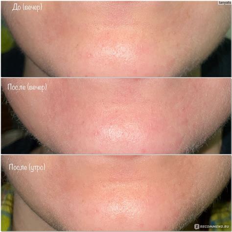 Пилинг для лица The Ordinary AHA 30% + BHA 2% Peeling Solution ...