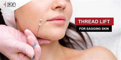 thread lift   expect cost risk procedures   sian