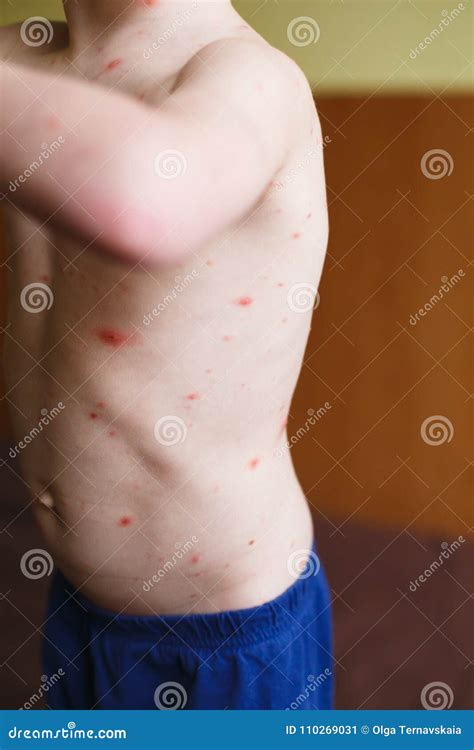 Baby With Chicken Pox Rash. Varicella Virus Or Chickenpox Bubble Rash ...