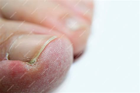 Dedos Descascando Perto Das Unhas - Descascando a pele dos dedos em um fundo branco seu artigo sobre ...