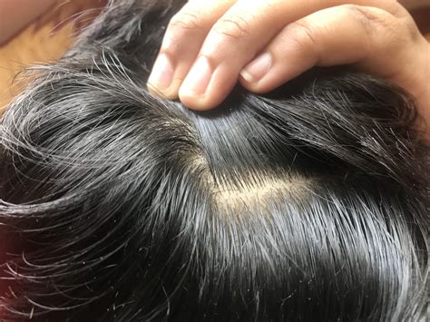 can dandruff make you lose hair 6