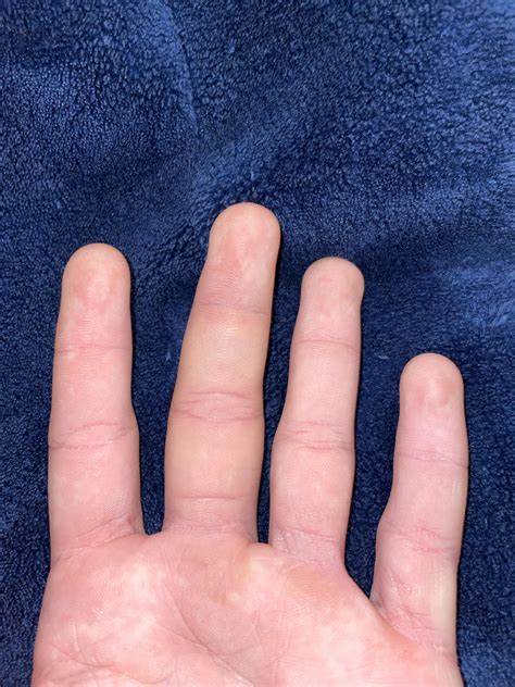 hurt my middle finger friday, looks crooked. how do i fix it ? : r/medical