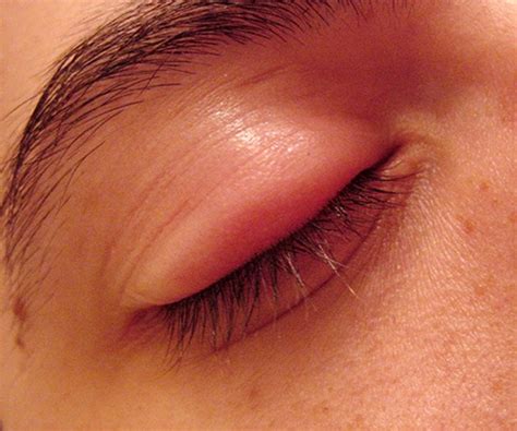 Eyelid Swollen Symptoms Causes Treatment Angleton Er - vrogue.co