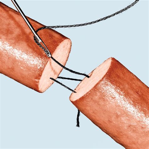 This Is the Story of America's First Penis Transplant