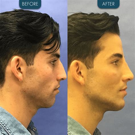 chin implant    zaren health