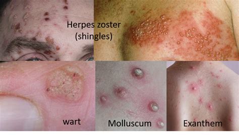 What Is A Viral Infection Rash at Lester Mitchell blog