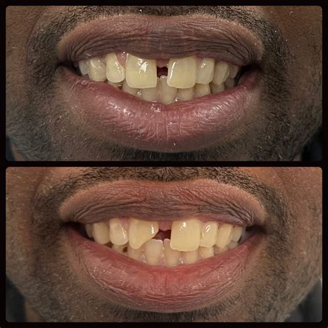 chipped front tooth - STL Mid-County Dental