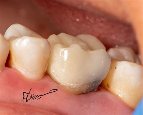 How to manage so destroyed molar ?! - MyZerodonto