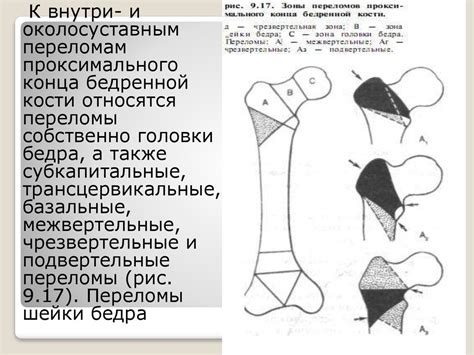 Переломы нижних конечностей - презентация онлайн
