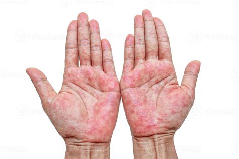 Hands with rash. Red sports on the hand, palm and fingers. 11347545