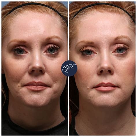 frown line still there after botox 5