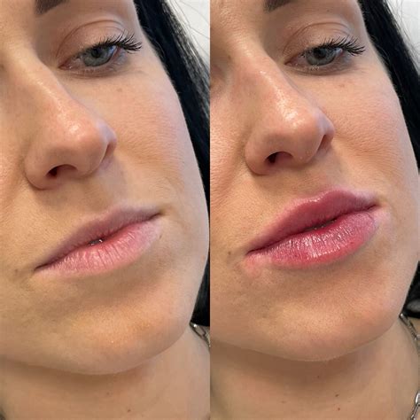 How Long Does A Lip Filler Treatment Take? – It's Me & You
