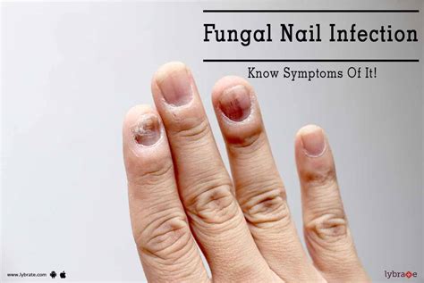 Common Fingernail Infections - Design Talk