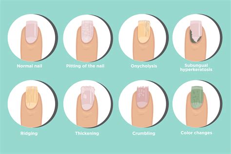 Psoriatic Arthritis Nail Changes: Symptoms and Treatments