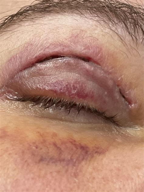 upper bleph day  stitch removal dehiscence rhoodedeyes