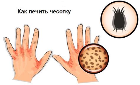 Как лечить чесотку - Перерождение