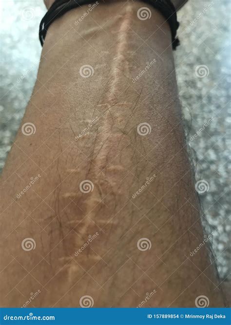 Forearm Stitches