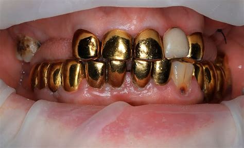 Циркониевые коронки | Цирконий зубы в стоматологической клинике Eurodental