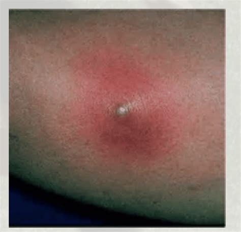 Spider Bites Pictures And Symptoms