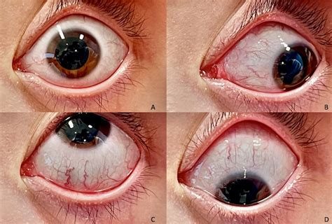 Sutureless Peritomy Sparing Scleral Buckle in Pediatric Patients