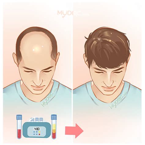 Best PRP Therapy for Hair Loss in Kuching - Price Guide & Reviews