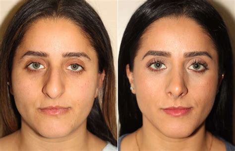 How To Make Nose Thinner Without Makeup Or Surgery - Mugeek Vidalondon