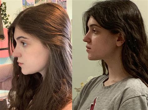 EmileExo's OnlyFans Transformation: A Before & After You Won't Believe - pfm61wh