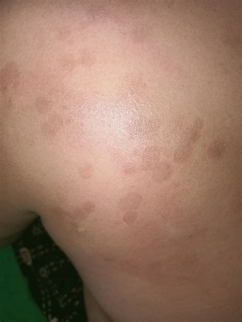 ruam merah  hitam menyebar tapi tidak gatal hellosehat